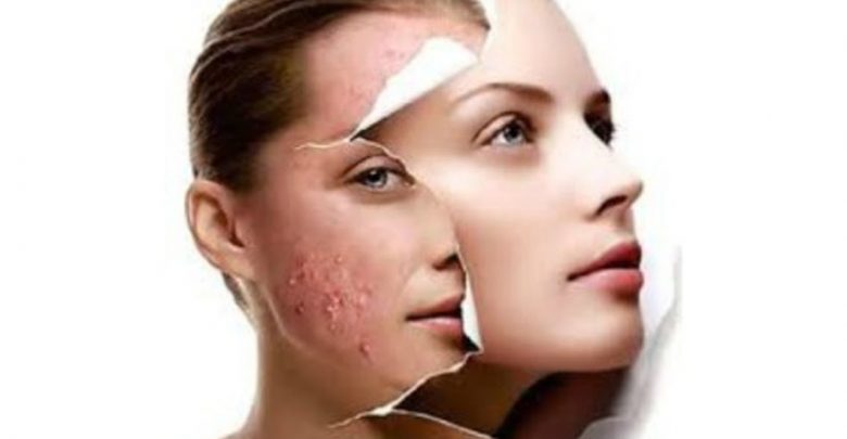 علاج مشاكل البشرة Skin problems
