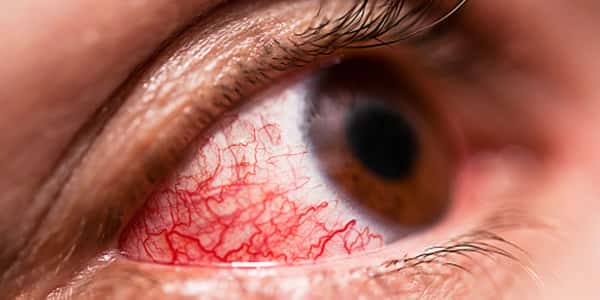 أسباب التهاب ملتحمة العين - مجلة رجيم