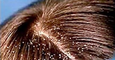 4 طرق علاج قشرة الشعر