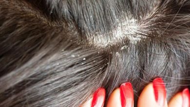 أفضل 10 مكونات طبيعية للقضاء على قشرة الشعر الصعبة