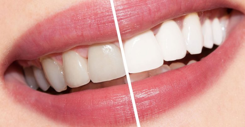 أفضل الطرق لتبيض الاسنان