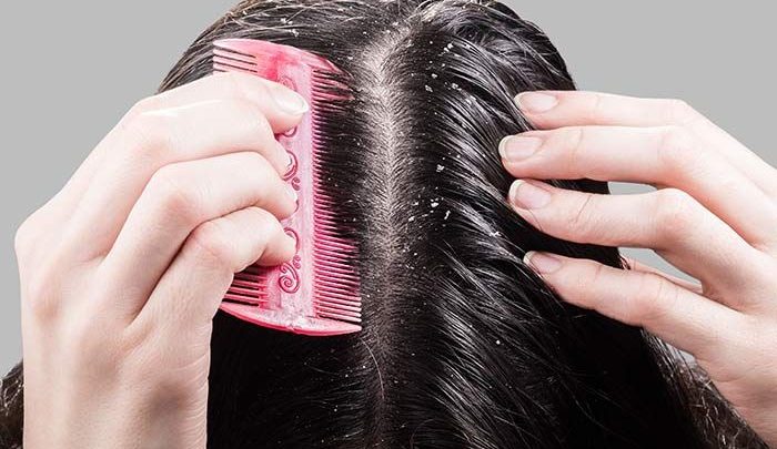 8 أسرع وصفات لعلاج قشرة الشعر