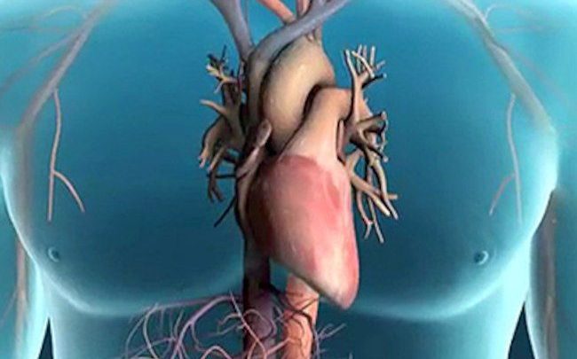 مضاعفات القسطرة القلبية