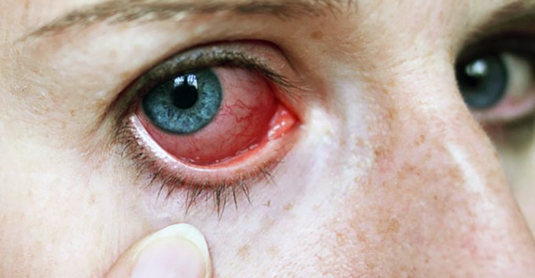 علاج التهاب العين واحمرارها