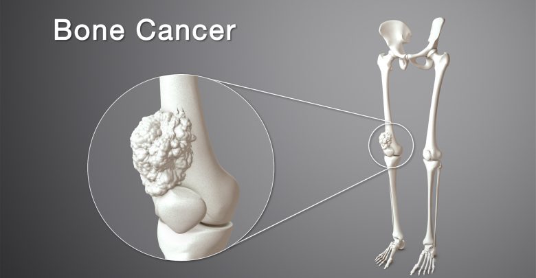 اعراض سرطان العظام
