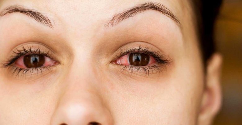 علاج التهاب العين