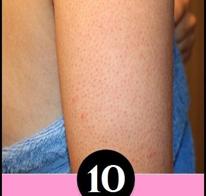10 طرق للتخلص من جلد الوزة سهلة وسريعة