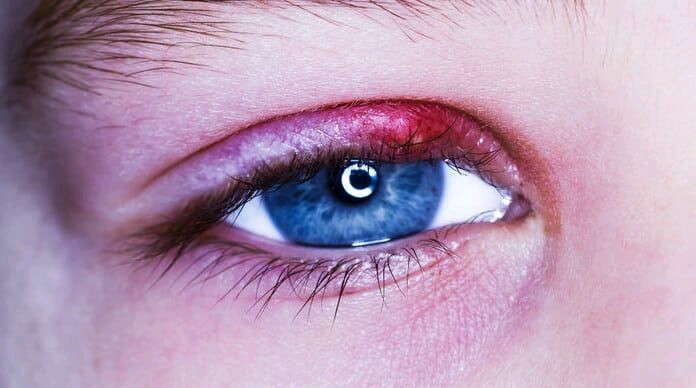 علاج تورم العين