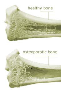 الفرق بين العظام الطبيعية وهشاشة العظام