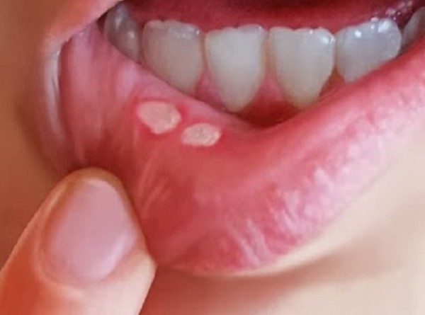 فطريات الفم