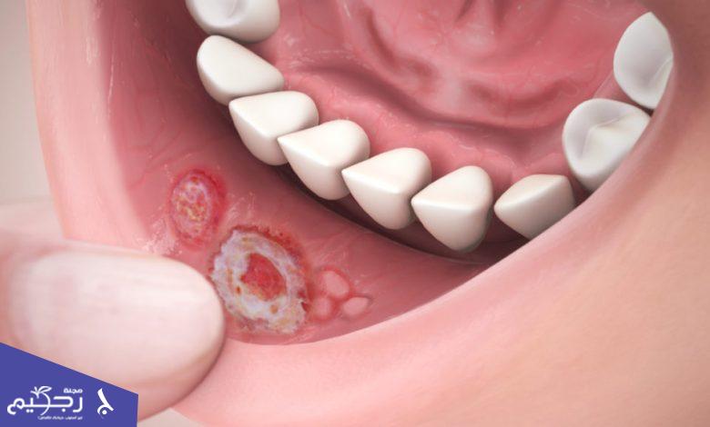 أفضل 9 طرق لعلاج تقرحات الفم