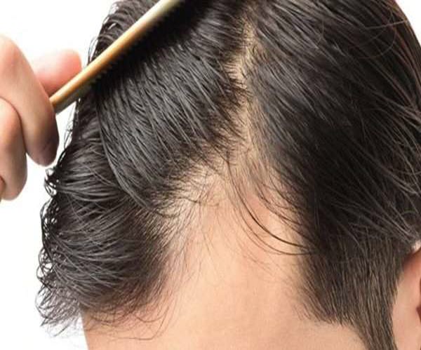 فعالية فوائد مينوكسيديل لإنبات الشعر